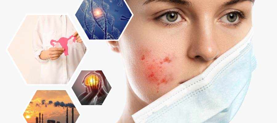 the causes of acne and prevent